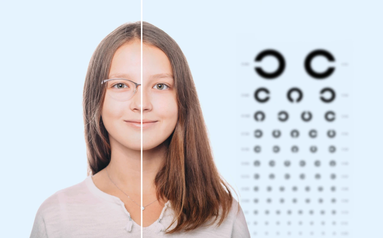 Mädchen mit Brille auf einer Seite und ohne Brille auf der anderen – Brille oder Kontaktlinsen bei Myopie?